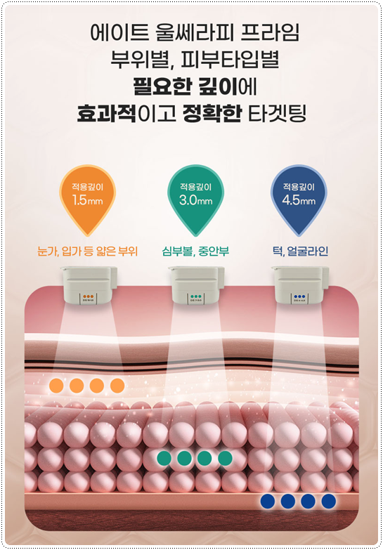 What Is the Difference Between 100 Shots and 300 Shots of Ulthera? Let’s Also Look at Ultherapy Prime Pricing and When Lifting Effects Appear image 14