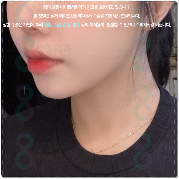 피부과 추천 정보? 울쎄라 강남 어디가 잘하는곳인가요? 수면마취, 가격 부담없이 하는법 관련 이미지 3