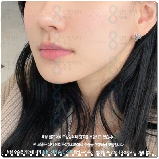 울쎄라 300샷 가격과 효과는? 100샷 후기&middot;전후 차이까지 비교 관련 이미지 4