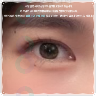 쌍커풀 하고 앞트임 수술을 해도될까? 쌍수 이후 라인 변화에 대해서 관련 이미지 2