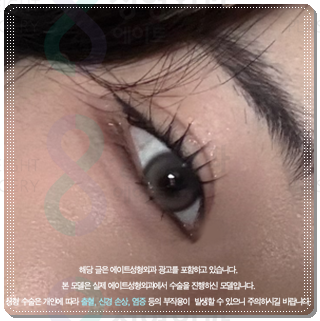 How Much Does Non-Incisional Double-Eyelid Surgery Cost? Comparing Suture and Incisional Methods image 3