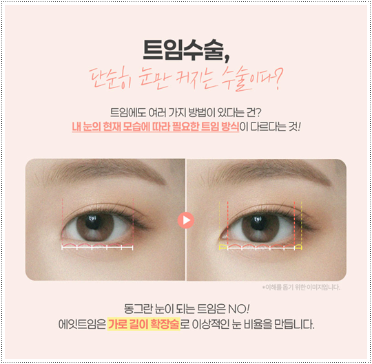 눈 앞트임과 윗트임 준비, 내돈내산 후기를 찾아볼 때 수술 전후 확인할 것 (비용 등) 관련 이미지 6