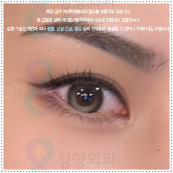 눈 앞트임과 윗트임 준비, 내돈내산 후기를 찾아볼 때 수술 전후 확인할 것 (비용 등) 관련 이미지 1