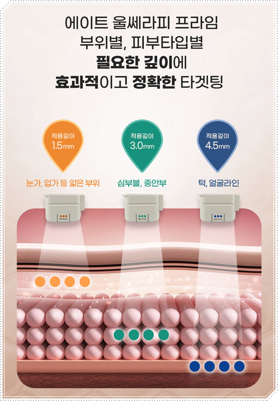 울쎄라피프라임 효과 얼마나 갈까? 300샷 통증과 후기, 가격까지 관련 이미지 14