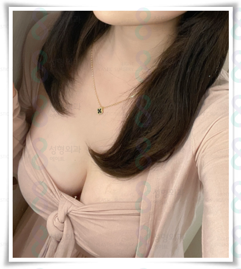 모티바 가슴수술 가격? 수술 후 촉감, 구형구축 문제없나요? 관련 이미지 3