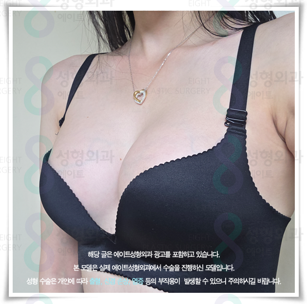 강남 가슴성형, 수술 전 비용보다 부작용을 먼저 봐야 하는 이유 관련 이미지 3
