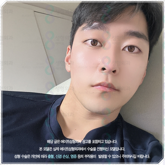 남자 코성형 종류 어떤 게 맞을까? 평균 비용부터 회복기간, 발품 팁까지 완벽 가이드 관련 이미지 4