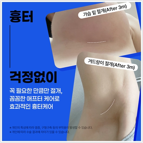How much does breast ptosis surgery cost, and why do prices differ? image 7