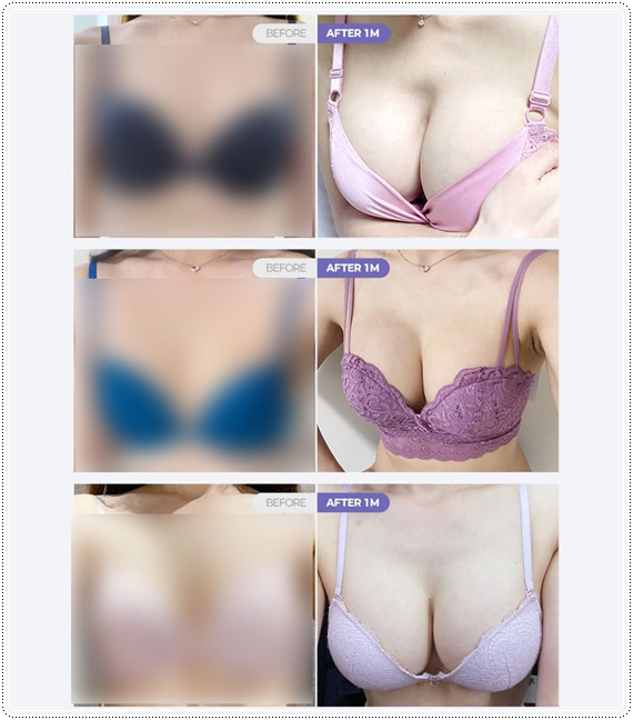How to Find a Well-Known Breast Plastic Surgery Clinic in Seoul’s Gangnam District: Selection Criteria and Points to Check image 8