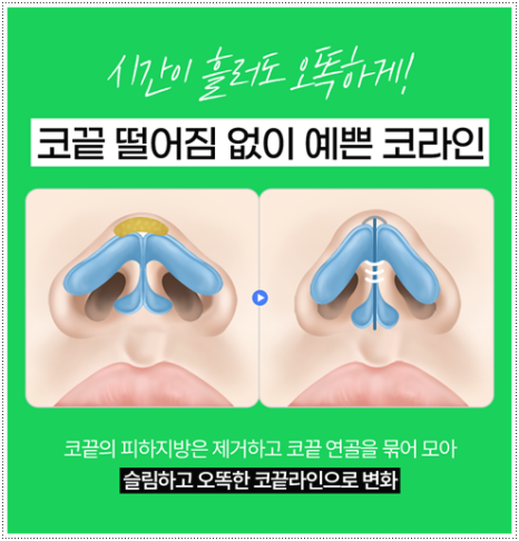 코수술 후기 일주일 1개월 비교? 평균 비용, 코성형 종류 장단점은? 관련 이미지 11