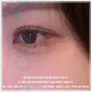 눈밑수술과 쌍꺼풀 같이해도될까? 눈밑지방재배치 쌍수 방법, 비용과 회복기간은? 관련 이미지 2