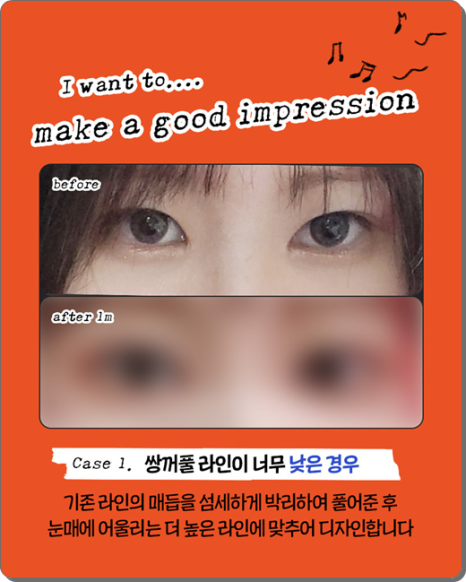 실패 없는 쌍꺼풀 재수술을 위해: 매몰법 특징부터 비용, 시기별 붓기 회복 과정 관련 이미지 11