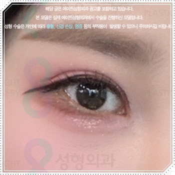 내 눈에 맞는 앞트임 필요할까? 수술 방법과 대략적인 비용 안내 관련 이미지 1