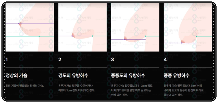 처진가슴수술 비용 (가격), 처짐 개선 방법은? 후기, 회복기간 어떤가요? 관련 이미지 6