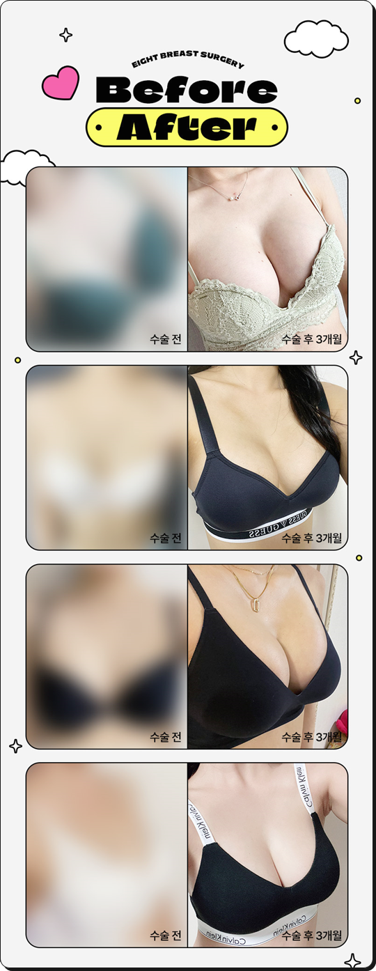 가슴확대수술비용 어떻게 비교하나요? 관련 이미지 13