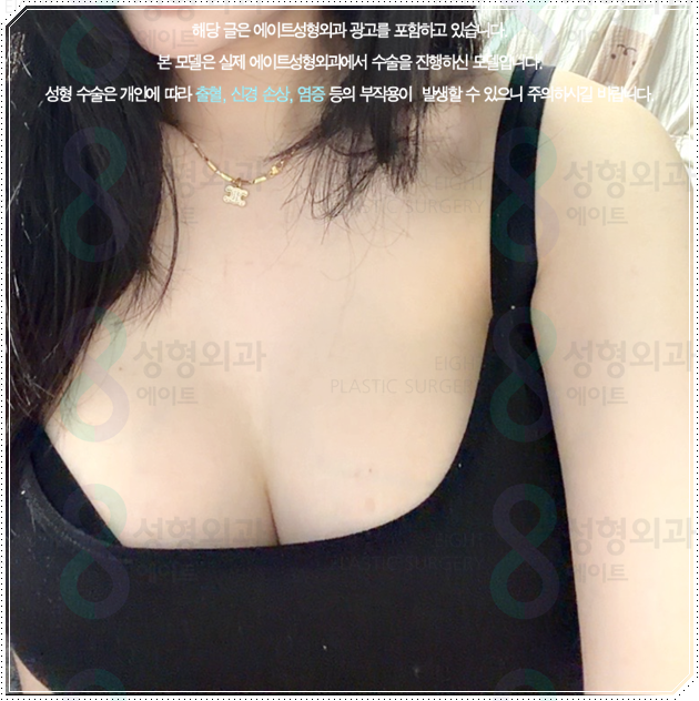 Why Do Breast Augmentation Surgery Prices Differ by Type, and How Can You Avoid Side Effects? image 5