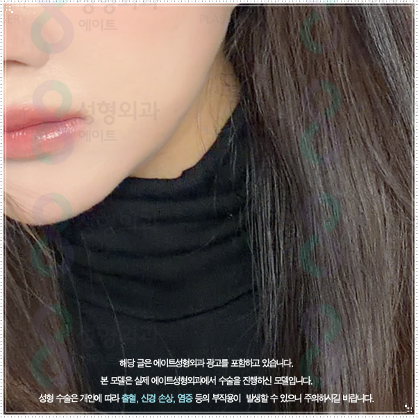 처지는 피부 고민? 리프팅 중 울쎄라 100샷은 300샷과 가격이나 효과가 많이 다른가요? (울쎄라피프라임) 관련 이미지 3