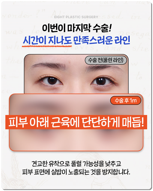 쌍꺼풀 라인을 다시 잡는 재수술, 매몰 방법과 비용은? 관련 이미지 11