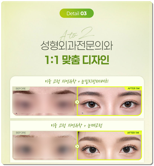How Much Does Non-Incisional Double-Eyelid Surgery Cost? Comparing Suture and Incisional Methods image 11