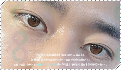 남자 쌍수 비용, 눈매교정 · 앞트임까지 하면 얼마나 달라질까? 관련 이미지 5