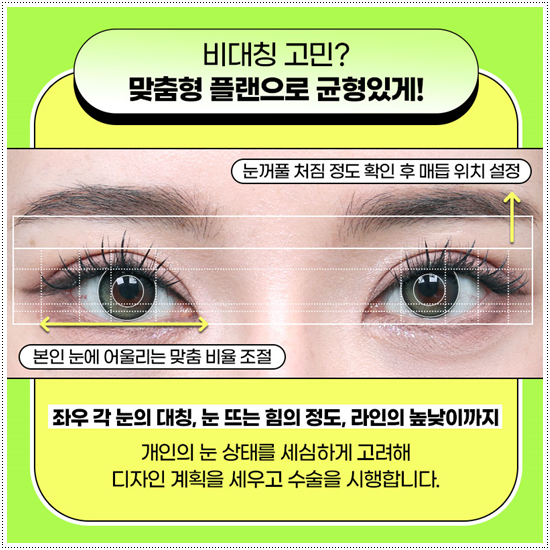 쌍꺼풀 자연유착과 매몰, 절개 사이에서 고민이라면? 비용과 풀림 가능성을 낮추는 수술 방법은? 관련 이미지 8