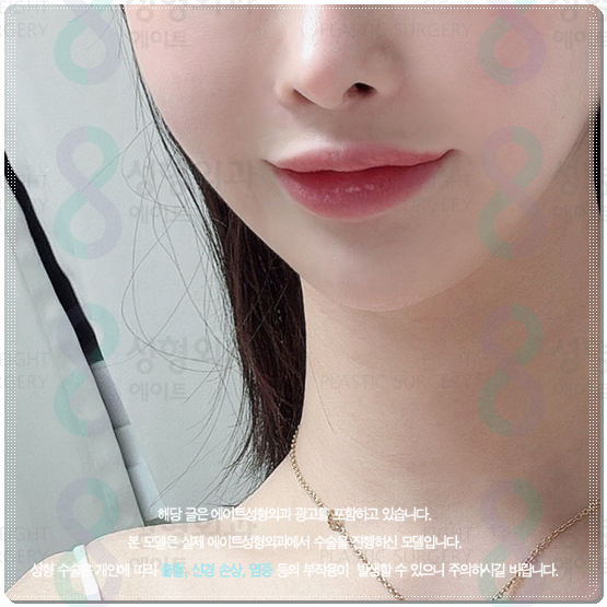 Gangnam) How Much Does 300 Shots of Ultherapy Cost? Treatment Time, Frequency, and Before-and-After Results (Ultherapy PRIME) image 1