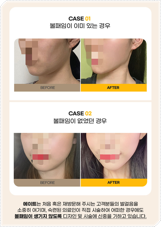 울쎄라피프라임 효과 얼마나 갈까? 300샷 통증과 후기, 가격까지 관련 이미지 12