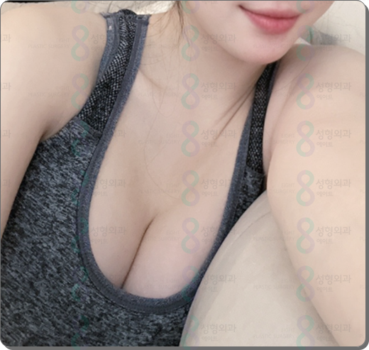가슴 보형물 종류 모티바 특징 무엇인가요? 관련 이미지 4