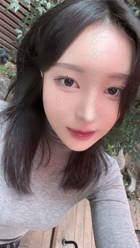 압구정눈매교정 눈매교정잘하는곳 눈매교정유명한병원 안검하수잘하는병원 관련 이미지 2