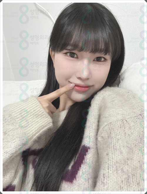 매부리코수술 비용, 왜 병원마다 차이가 날까? 관련 이미지 5