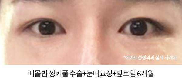 남자눈성형전후 비교해본다면 관련 이미지 4