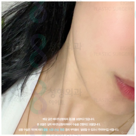 울쎄라 리프팅은 300샷으로 어느정도 효과가 있을까? 관련 이미지 3