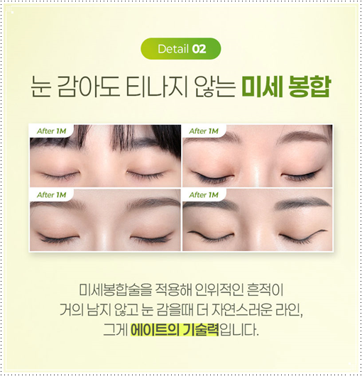 자연유착 쌍꺼풀 수술 후기 | 압구정 쌍수 밑트임 후 붓기 한달 변화 참고 후기 관련 이미지 10