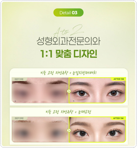 Natural Double Eyelid Surgery Using the Non-Incisional Method: A Budget and Consultation Guide for Middle School Students’ Eye Shapes Before and After Surgery image 13