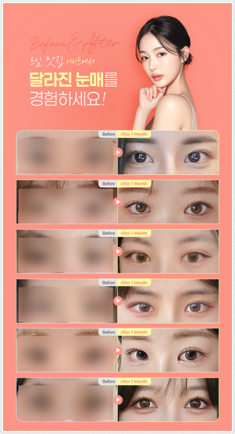 What Are the Prices and Combined Effects of Epicanthoplasty and Upper Epicanthoplasty with Double Eyelid Surgery? From Eye Shape Changes in Reviews of Front-and-Upper Epicanthoplasty to the Differences image 6