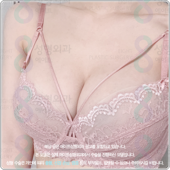 How Much Does Breast Augmentation with Mentor Xtra Cost? What to Know About Feel and Precautions Before and After Surgery image 3
