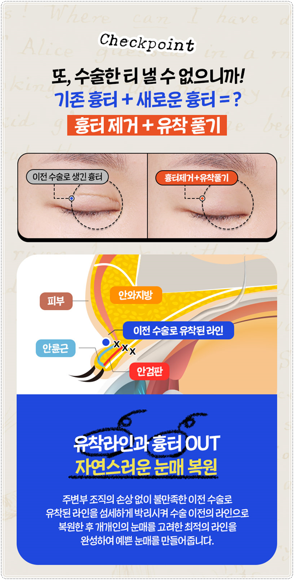 첫 쌍꺼풀 수술을 절개로 하고 눈 재수술은 매몰법(자연유착)으로 못하나? 비용 붓기는? 관련 이미지 15