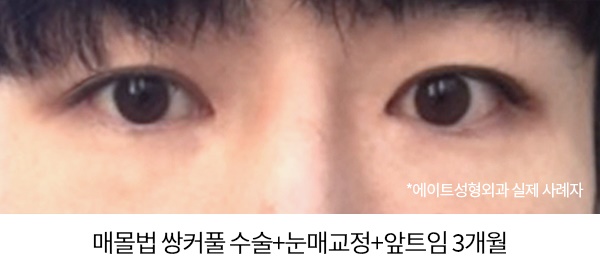 남자눈성형전후 비교해본다면 관련 이미지 3