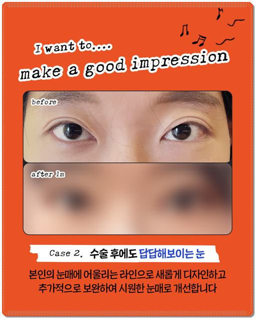 쌍꺼풀 라인을 다시 잡는 재수술, 매몰 방법과 비용은? 관련 이미지 8