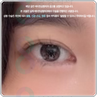 쌍커풀 하고 앞트임 수술을 해도될까? 쌍수 이후 라인 변화에 대해서 관련 이미지 1