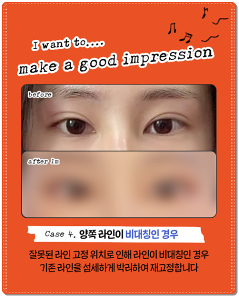 수술 가격이 다른 이유? 매몰과 절개 어떤 쌍꺼풀 재수술을 해야할까? 관련 이미지 13