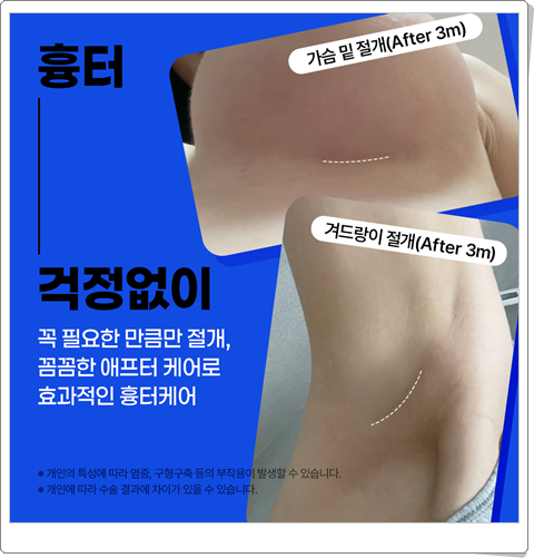 가슴확대수술비용 부작용 가능성을 낮추려면? 관련 이미지 19