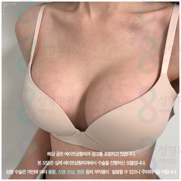 모티바 보형물이 가슴 수술의 가격 차이가 나는 이유? (부작용 증상을 낮추는법) 관련 이미지 3