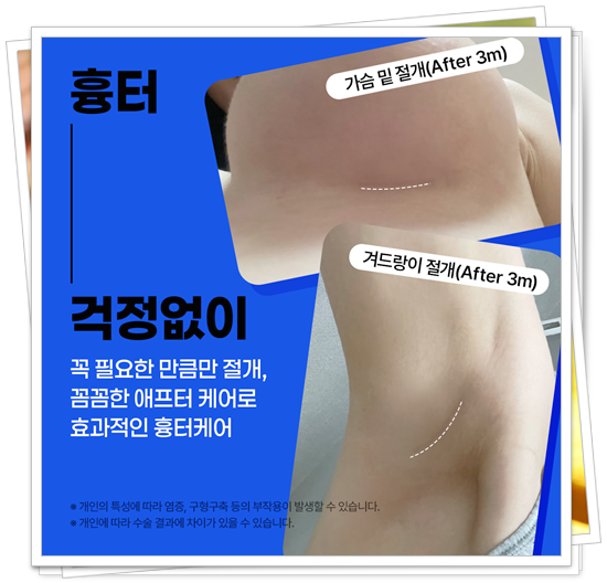 Breast Ptosis Surgery Price, How Are the Reviews? image 12