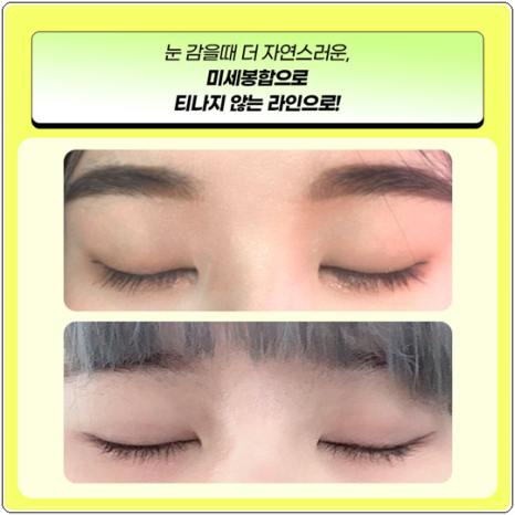 자연유착 매몰, 절개 차이 비교해봐요. 풀림 걱정없이 눈성형 비용과 후기 참고하는법 관련 이미지 7
