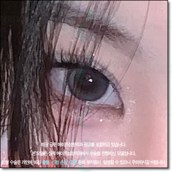 A Review of Upper Blepharoplasty Costs That Was Worth Every Penny! From How to Remove Mongolian Folds to Pricing and Recovery Care Tips image 4
