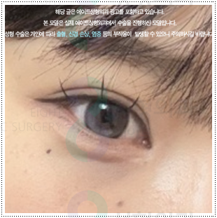매몰쌍수와 앞트임 그리고 뒷트임, 밑트임까지 같이해도되나요? 관련 이미지 5