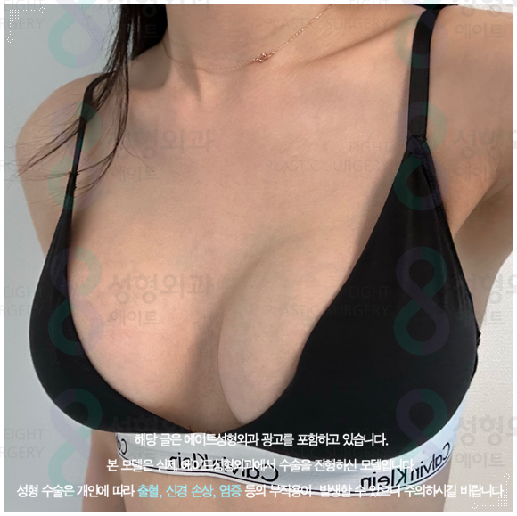모티바 보형물이 가슴 수술의 가격 차이가 나는 이유? (부작용 증상을 낮추는법) 관련 이미지 5