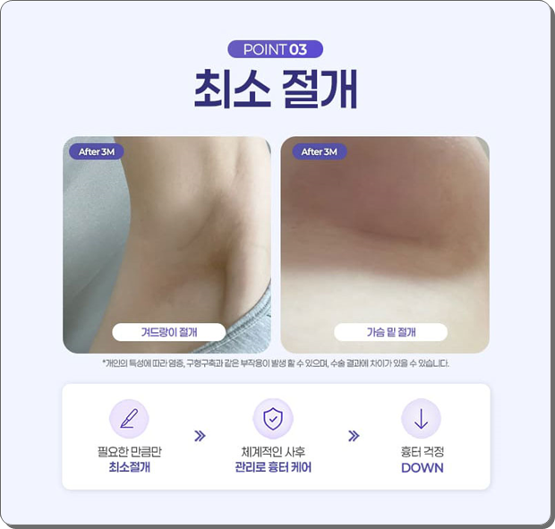 압구정역 가슴수술, 성형외과 추천? 멘토 엑스트라는 비용 전에 가슴 트레이닝센터, 의사를 확인 관련 이미지 14