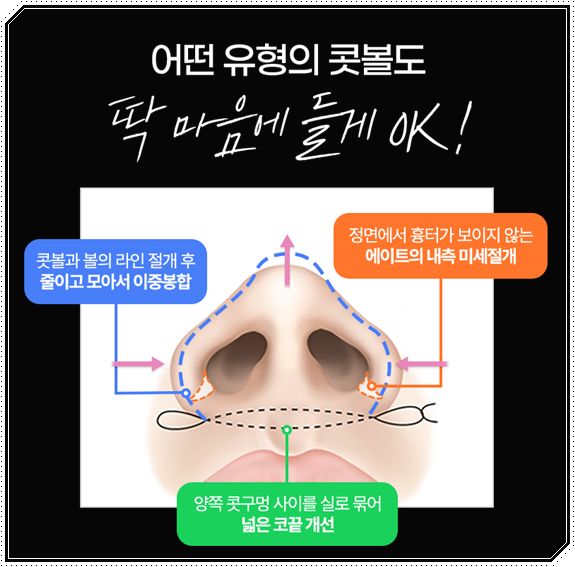 남자 코성형 종류 어떤 게 맞을까? 평균 비용부터 회복기간, 발품 팁까지 완벽 가이드 관련 이미지 20